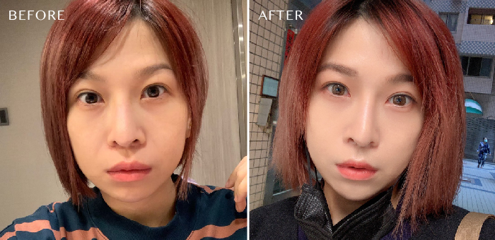 墊下巴手術案例 墊下巴手術案例