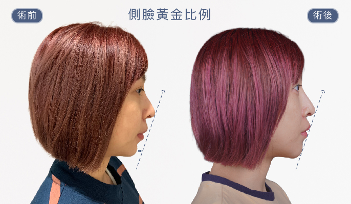 墊下巴手術心得 墊下巴手術心得