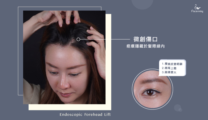 內視鏡前額拉皮微創傷口 內視鏡前額拉皮微創傷口