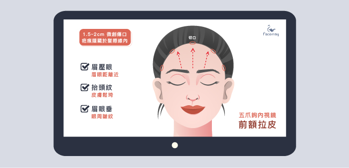 內視鏡前額拉皮優點 內視鏡前額拉皮優點