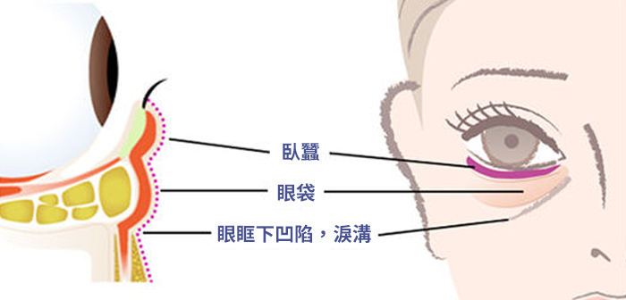 眼袋、臥蠶傻傻分不清？1個小動作就能分辨！