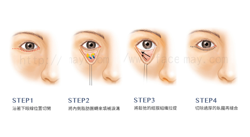 眼袋手術（眼袋內開、眼袋外開）介紹與案例分享
