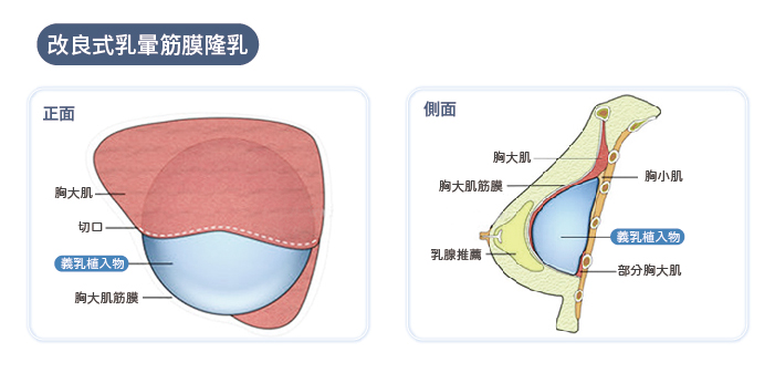 果凍矽膠隆乳好嗎 ,圓盤絨毛差在哪,會莢膜攣縮嗎