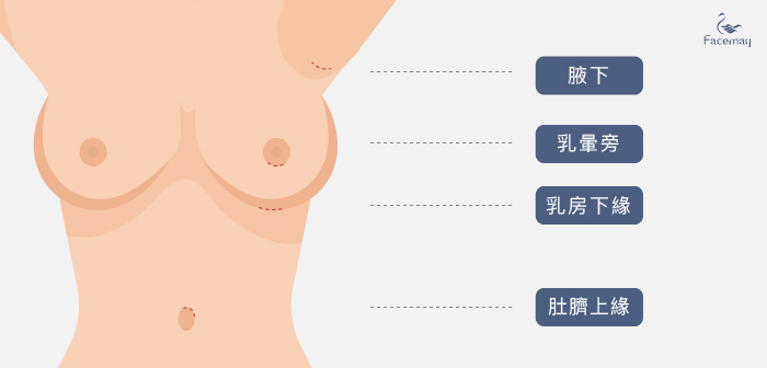 隆乳傷口，隆乳腋下傷口，隆乳傷口，隆乳案例，隆乳分享，隆乳費用，隆乳對比，隆乳心得_