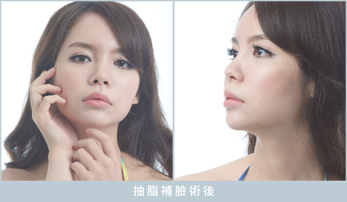 自體脂肪豐頰,抽脂補臉,威塑抽脂,自體豐胸,菲仕美,台中自體脂肪補臉,自體脂肪補臉案例分享,抽脂補臉 自體脂肪豐頰,抽脂補臉,威塑抽脂,自體豐胸,菲仕美,台中自體脂肪補臉,自體脂肪補臉案例分享,抽脂補臉