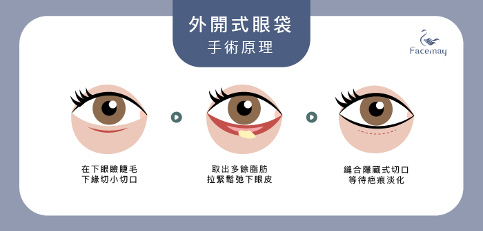 眼袋外開與眼袋外開比較。眼袋外開手術原理，眼袋外開手術優勢