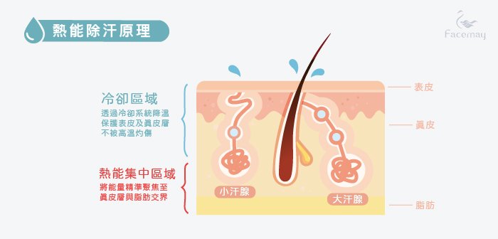 miradry清新微波熱能止汗術案例，miradry清新微波原理，狐臭止汗案例，治療狐臭多汗症