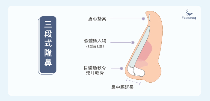 韓式隆鼻，韓式鼻雕，台中隆鼻推薦，隆鼻推薦，隆鼻案例分享，三段式隆鼻，三段式隆鼻優勢，三段式隆鼻是什麼，隆鼻醫師推薦，隆鼻權威