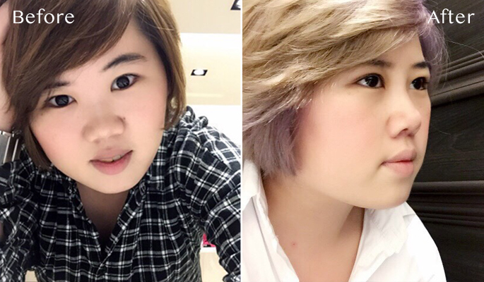 【三段式隆鼻(敲鼻骨+縮鼻翼)】菲仕美整形外科診所,短鼻人晚來的成年大禮,終於變身高鼻美人從小就特別在意自己的鼻子! 【三段式隆鼻(敲鼻骨+縮鼻翼)】菲仕美整形外科診所,短鼻人晚來的成年大禮,終於變身高鼻美人從小就特別在意自己的鼻子!