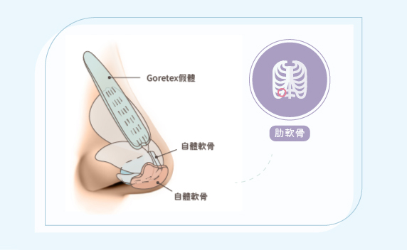 塌鼻者最適合於的手術方式莫過於三段式隆鼻，除了將鼻頭拉出海鷗線、山根墊高外，第三段就是墊高眉骨處,打造自然輕巧鼻