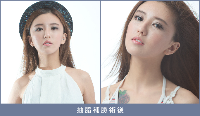 台中豐頰,台中自體脂肪豐頰,台中肉毒,台中自體脂肪,台中菲仕美診所,自體脂肪補臉,肉毒小腿,蘿蔔腿,自體脂肪豐額頭,自體脂肪推薦,自體脂肪補臉價格,自體脂肪補臉Dcard 台中豐頰,台中自體脂肪豐頰,台中肉毒,台中自體脂肪,台中菲仕美診所,自體脂肪補臉,肉毒小腿,蘿蔔腿,自體脂肪豐額頭,自體脂肪推薦,自體脂肪補臉價格,自體脂肪補臉Dcard