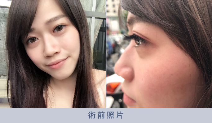 眼袋內開,眼袋內開推薦,台中眼袋內開推薦,眼袋內開案例,眼袋手術案例,眼袋外開,消除眼袋,眼袋手術推薦醫師,眼袋Dcard,眼袋手術費用,眼袋手術心得 眼袋內開,眼袋內開推薦,台中眼袋內開推薦,眼袋內開案例,眼袋手術案例,眼袋外開,消除眼袋,眼袋手術推薦醫師,眼袋Dcard,眼袋手術費用,眼袋手術心得
