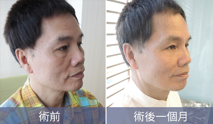 「外開眼袋手術」適合中老年族群、眼周肌膚嚴重鬆弛者。 「外開眼袋手術」適合中老年族群、眼周肌膚嚴重鬆弛者。