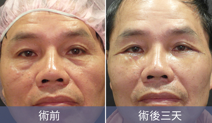 眼袋外開沿著下眼瞼睫毛下緣切小切口(約5mm-10mm)，依序分離眼輪匝肌、下眼眶中隔，將多餘的脂肪和鬆弛的肌膚去除後縫合。優點是能幫助眼下拉提、細紋撫平，缺點是術後需回診拆線、恢復期較長。