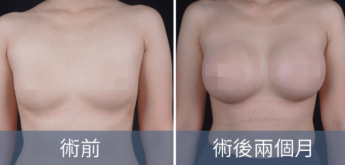 Motiva魔滴隆乳手術介紹,Motiva魔滴隆乳與其他果凍矽膠有何不同?台灣魔滴胸介紹,專業台中整形外科菲仕美診所 Motiva魔滴隆乳手術介紹,Motiva魔滴隆乳與其他果凍矽膠有何不同?台灣魔滴胸介紹,專業台中整形外科菲仕美診所