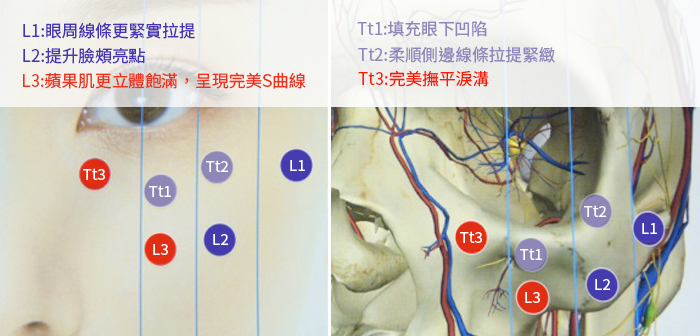 玻尿酸下巴價錢多少？會不會痛、維持多久？玻尿酸下巴價錢會依據下巴缺乏的狀況而決定使用的量，從1cc到4cc的注射都有