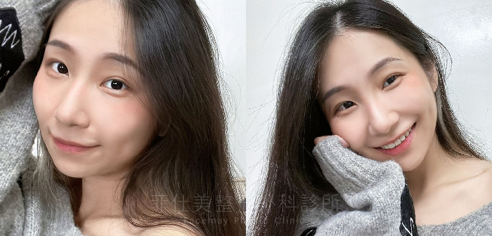 台中雙眼皮,縫雙眼皮dcard,雙眼皮貼,縫雙眼皮推薦醫師,縫雙眼皮術後,眼睛一單一雙,不對稱眼,縫雙眼皮手術諮詢,陳威臣醫師,縫雙眼皮案例,縫雙眼皮分享 台中雙眼皮,縫雙眼皮dcard,雙眼皮貼,縫雙眼皮推薦醫師,縫雙眼皮術後,眼睛一單一雙,不對稱眼,縫雙眼皮手術諮詢,陳威臣醫師,縫雙眼皮案例,縫雙眼皮分享