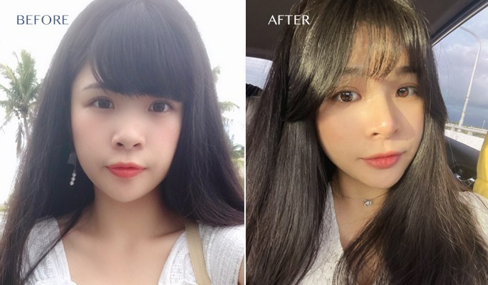 三段式隆鼻墊下巴案例術前後照片 三段式隆鼻墊下巴案例術前後照片