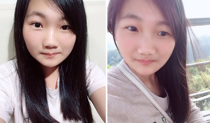 台中正顎權威---正顎手術費用多少?正顎要注意什麼?如何用正顎手術改善臉型與戽斗問題-菲仕美整形外科診所 台中正顎權威---正顎手術費用多少?正顎要注意什麼?如何用正顎手術改善臉型與戽斗問題-菲仕美整形外科診所