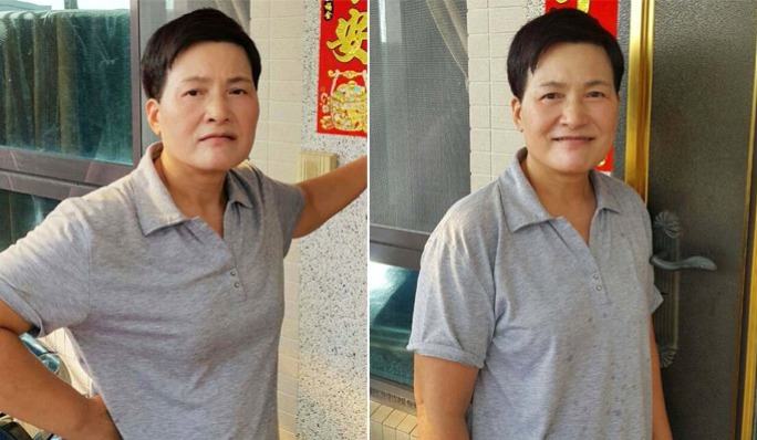外開法眼袋去除術,-鬆弛的眼皮所產生的皺紋。三週內可以完全消腫,成功的手術是完全不會影響視力的。 外開法眼袋去除術,-鬆弛的眼皮所產生的皺紋。三週內可以完全消腫,成功的手術是完全不會影響視力的。
