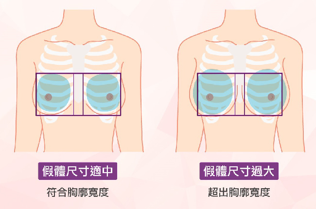 愛美新知-隆乳材質比較，隆乳材質怎麼選，最自然的隆乳材質，許永昌醫師，台中隆乳醫師推薦，曼陀，光滑面，絨毛面，圓盤型，水滴型，柔滴，女王波，魔滴，胸廓寬度，隆乳可以放多大