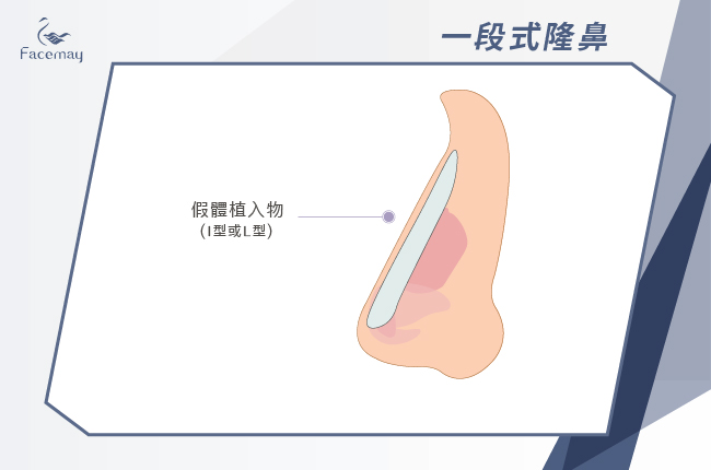 隆鼻手術方式_一段式隆鼻(傳統隆鼻)