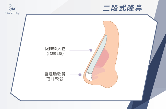 隆鼻手術方式__二段式隆鼻