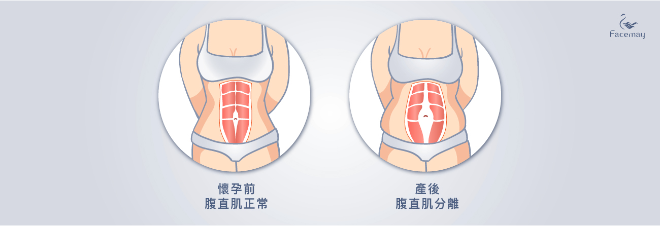 腹部拉皮手術，產後腹部鬆弛原因，腹直肌分離