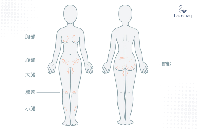 妊娠紋、肥胖紋、生長紋，皮膚擴張紋常見位置