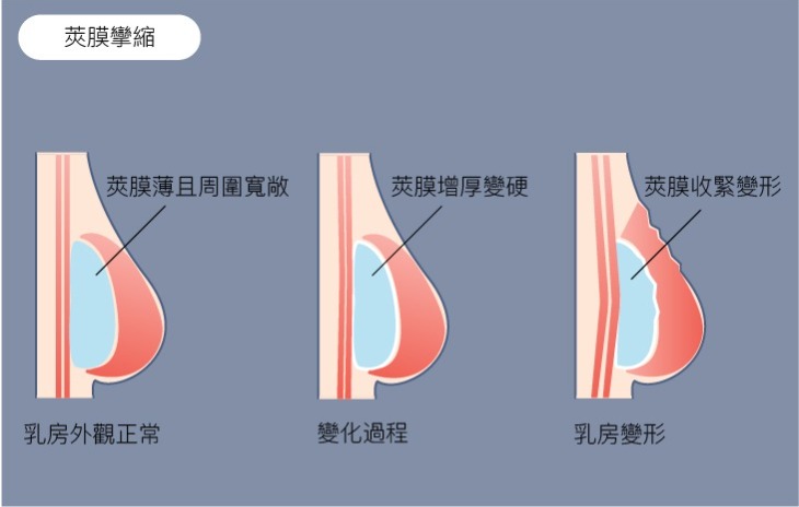 Mentor曼陀女王波,台中隆乳推薦,台中曼陀女王波,隆乳材質,曼陀女王波特色,2022隆乳材質,小骨架女生隆乳,台中隆乳權威,菲仕美整形外科診所,隆乳柔軟度,女王波12年保固,隆乳風險,女王波dcard,女王波案例 Mentor曼陀女王波,台中隆乳推薦,台中曼陀女王波,隆乳材質,曼陀女王波特色,2022隆乳材質,小骨架女生隆乳,台中隆乳權威,菲仕美整形外科診所,隆乳柔軟度,女王波12年保固,隆乳風險,女王波dcard,女王波案例