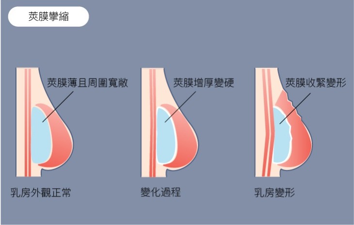 Mentor曼陀女王波，台中隆乳推薦，台中曼陀女王波，隆乳材質，曼陀女王波特色，2022隆乳材質，小骨架女生隆乳，台中隆乳權威，菲仕美整形外科診所，隆乳柔軟度，女王波12年保固，隆乳風險，女王波dcard，女王波案例