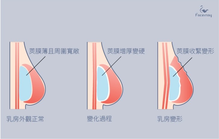 Mentor曼陀女王波，台中隆乳推薦，台中曼陀女王波，隆乳材質，曼陀女王波特色，2022隆乳材質，小骨架女生隆乳，台中隆乳權威，菲仕美整形外科診所，隆乳柔軟度，女王波12年保固，隆乳風險，女王波dcard，女王波案例