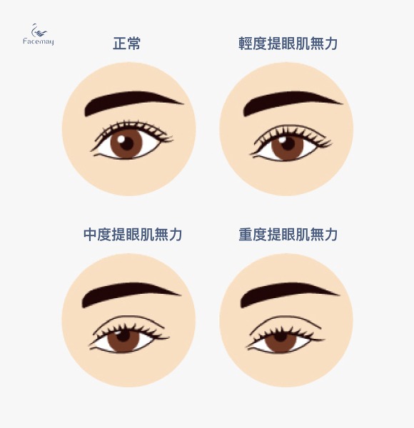 提眼肌手術時常會和雙眼皮手術合併施作,讓整體眼睛比例更加和諧。 如何判斷是否有提眼瞼肌無力?