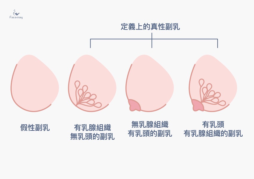 把提眼肌腱膜縮短或摺疊,加強提眼肌收縮時產生的力量,達到完全而且對稱性地打開雙眼。_工作區域 1 副乳的種類有哪些? 是真性副乳還是假性副乳?