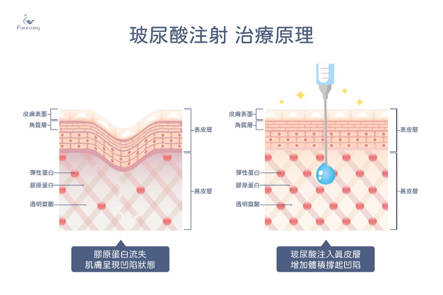 玻尿酸注射治療原理