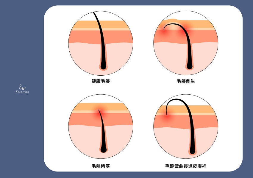 什麼是毛髮倒生？為何除毛後容易發生？