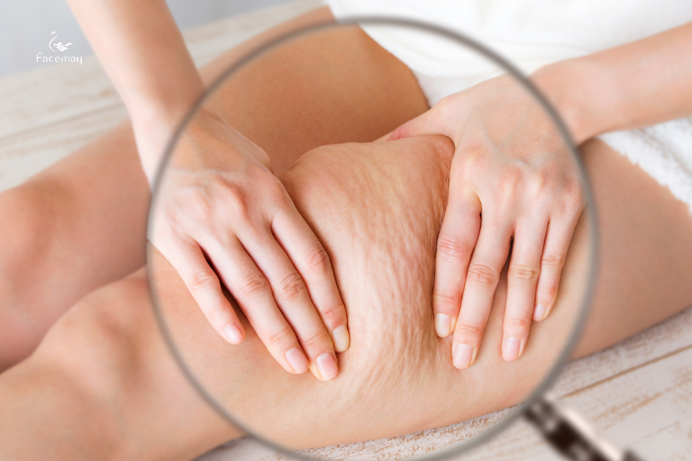 FitMe韓國完形美臉部植入物：打造專屬你的自然輪廓