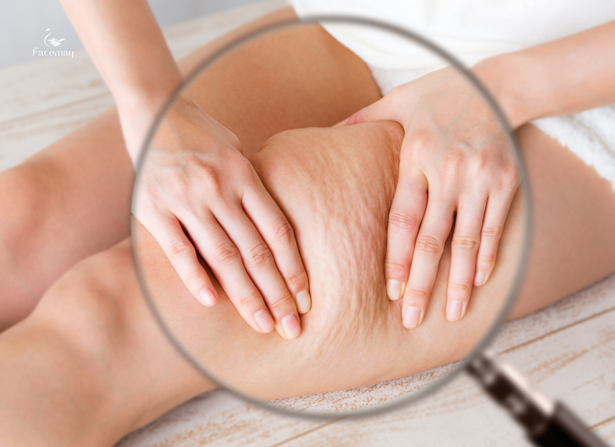 瘦了卻不敢露？別讓肥胖紋/妊娠紋 成了你的『美中不足』！