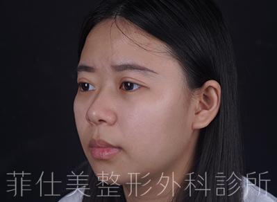 菲仕美陳威臣醫師｜割雙眼皮