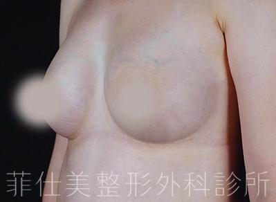 許永昌醫師｜魔滴隆乳