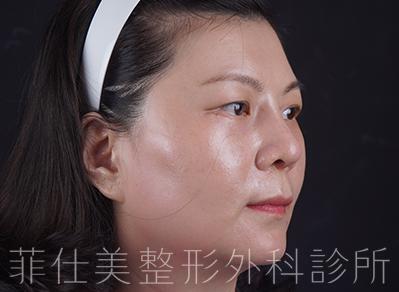 菲仕美院長楊學穎醫師｜三段式隆鼻+眼袋內開