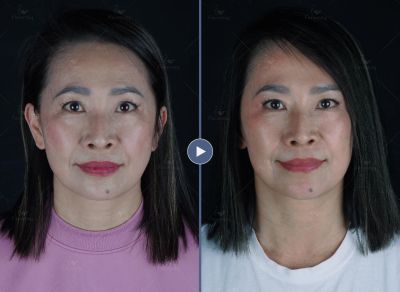 肉毒皺眉紋及小臉｜菲仕美姜彥任醫師
