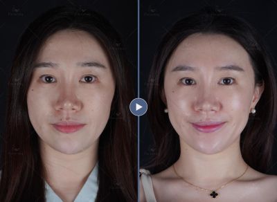 鳳凰電波｜菲仕美楊學穎醫師