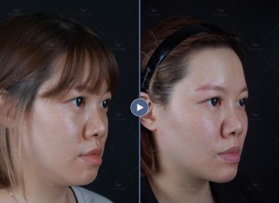 喬雅登Voluma+Volite｜菲仕美許永昌醫師