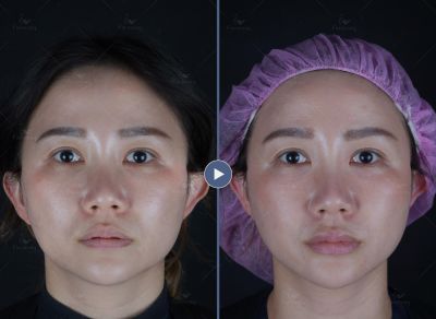 喬雅登豐唇+下巴｜菲仕美許永昌醫師