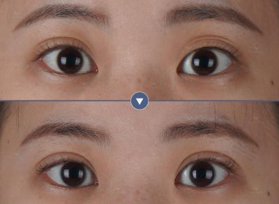 縫雙眼皮+嘟嘟唇｜菲仕美許永昌醫師