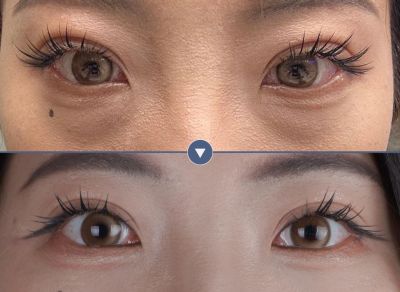 眼袋內開｜菲仕美陳盈婷醫師