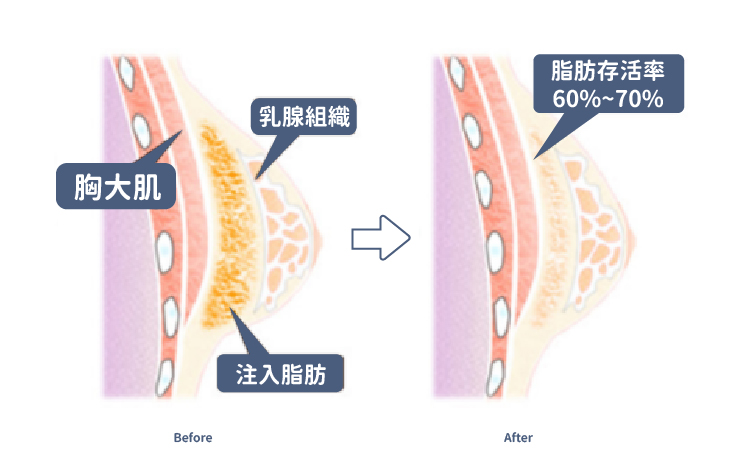 大腿抽脂台中自體脂肪隆乳費用-05