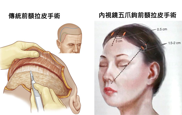 五爪鉤約在手術後2年就可以完全被人體吸收，不需擔心有異物殘留。