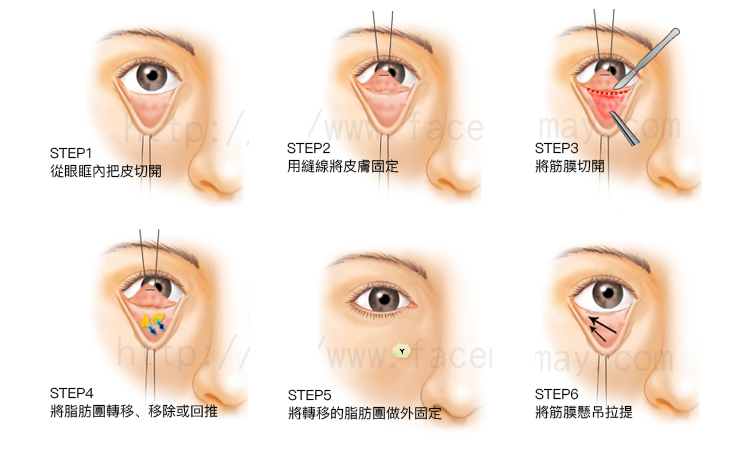 眼袋那一整個區塊都是會澎起來的脂肪眼袋內開加補淚溝美麗見證